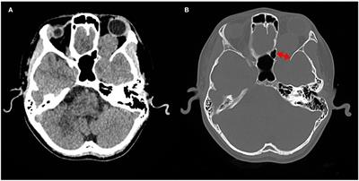 Pediatric dumbbell-shaped orbital schwannoma with extension to the cranial cavity: A case report and literature review